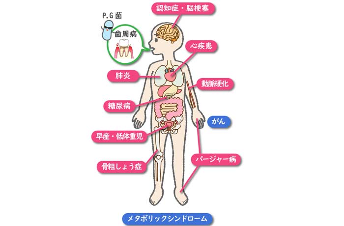 歯周病が全身に及ぼす影響。糖尿病、心疾患、脳梗塞、認知症などとの関連性を示す解説図