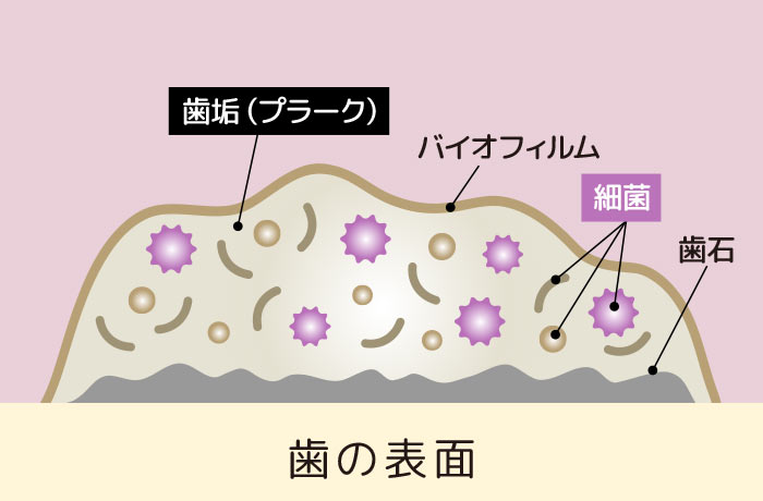 歯の表面に付着した歯垢(プラーク)・バイオフィルム・細菌・歯石の位置関係を示す断面図